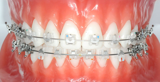 치아교정